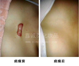 祛斑之后也不能掉以輕心，成都神奇魔斑告訴您有這些注意事項(xiàng)